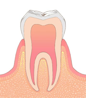 C0：虫歯の初期段階