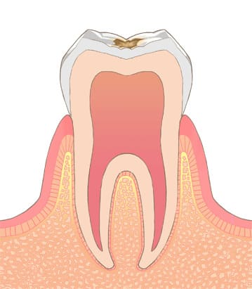 C1：エナメル質が虫歯
