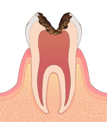 C3：神経まで虫歯が到達