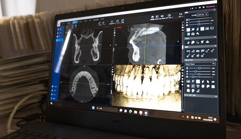 CTを利用した歯周病治療